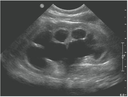 Clasificación de la Sociedad de Urología Fetal (SFU) Grado IV: Visualización de