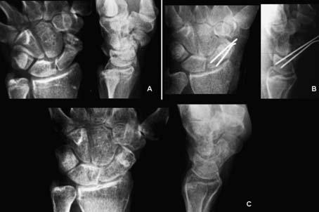 PROBLEMÁTICA Y TRATAMIENTO ACTUAL DE LA SEUDOARTROSIS DE ESCAFOIDES Figura 2: Varón de 17 años que acude por dolor en tabaquera anatómica de la mano izda.