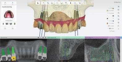 Capture más casos de restauraciones de implantes ofreciendo guías quirúrgicas El software Implant Studio de 3Shape facilita a que