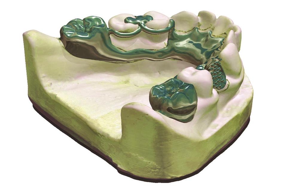 Diseño de prótesis parciales removibles comienza con los dientes virtuales Las mejoras revolucionarias dentro de la impresión 3D hacen que la producción RPD digital sea más rentable para los