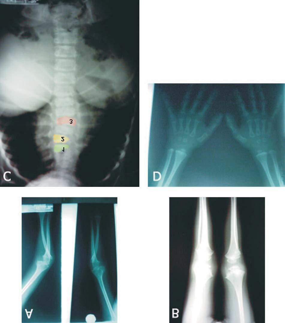Displasia espóndilo-epifisiaria 557 Fig. 3. Radiología.