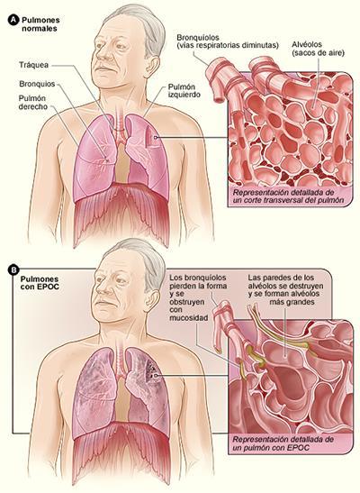 1. INTRODUCCIÓN La enfermedad pulmonar obstructiva crónica (EPOC) es definida por la iniciativa GOLD (Gobal initiative for chronic Obstructive Lung Disease) como una enfermedad prevenible y tratable