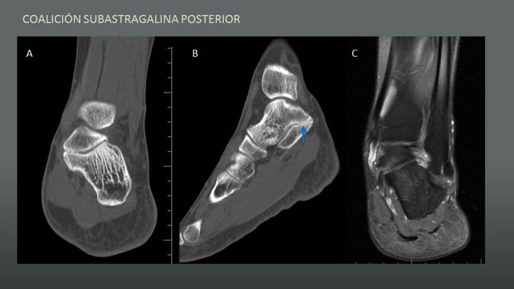 Fig. 4: COALICIÓN SUBASTRAGALINA POSTERIOR A y B: Imágenes de TC en plano coronal y sagital donde se muestra un estrechamiento anómalo entre carillas articulares de subastragalina posterior