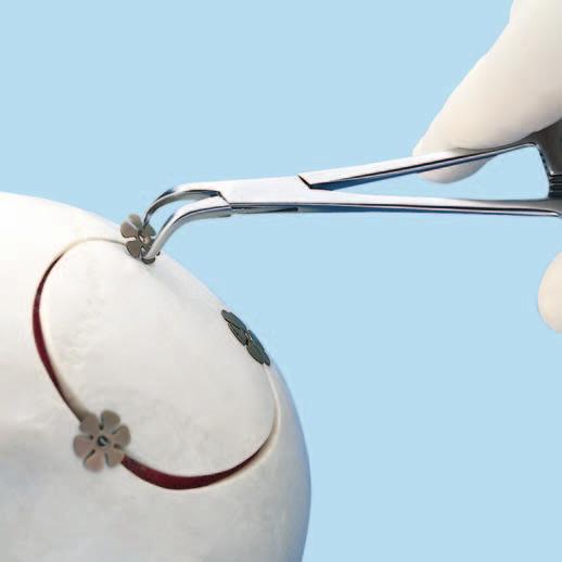 Extracción de los implantes Extracción de los implantes Instrumento 398.960 Pinzas de reducción, 120 mm Utilice unas pinzas de reducción para tomar el disco superior entre sus pétalos.