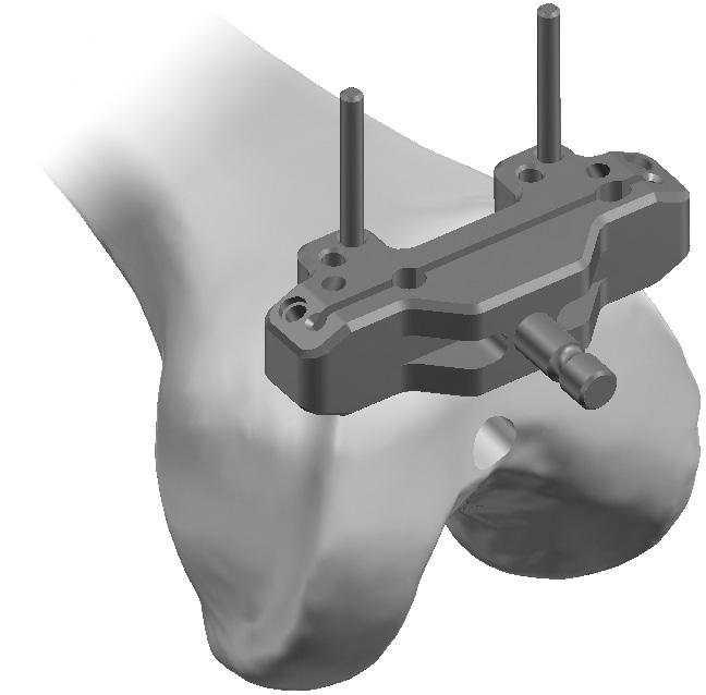 Resección de la porción distal del fémur NOT: Todas las guías de resección femoral ODYSSEY están diseñadas para su uso con una hoja de sierra de 1,3 mm (0,050 pulgadas) de grosor.