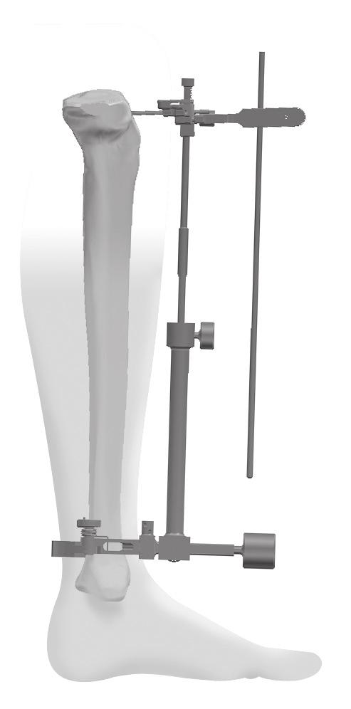 3. Preparación tibial NOT: Las guías de resección tibial ODYSSEY ha sido diseñadas para utilizarse con una hoja de sierra de 1,3 mm (0,050 pulgadas)
