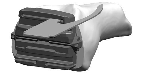 La distancia entre los estabilizadores de los pasadores en los laterales del bloque equivale a la anchura del componente femoral correspondiente.