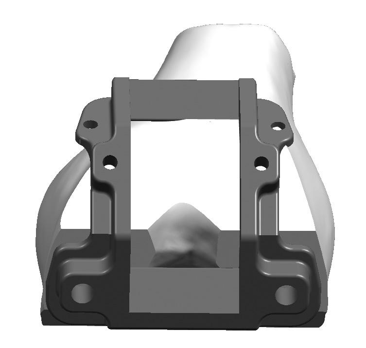 La de la FIGUR 34 La escotadura troclear debe seccionarse utilizando una hoja de sierra de 12,7 mm (1/2 pulgadas) en la superficie angulada y a lo largo de los lados de la porción central del bloque.
