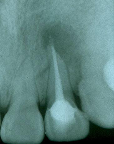 46,67%, de los cuales los molares son las piezas más afectados, con