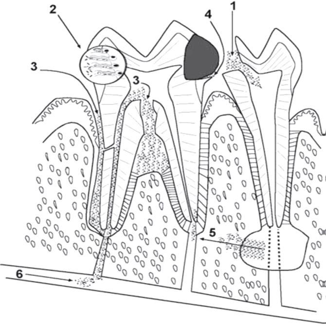 Figura 1 Principales vías de acceso de la Microbiota. 1: comunicación directa. 2: túbulos dentinarios. 3: vía periodontal. 4: filtraciones marginales. 5: contigüidad.