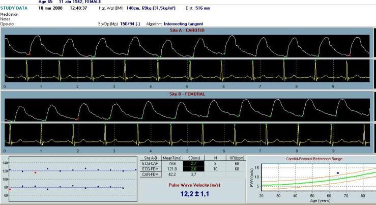 Metodología se analizó la onda del pulso en las arterias carótida y femoral, estimando el retraso con respecto a la onda del ECG y calculando la velocidad de la onda de pulso (VOP) (figura 5).