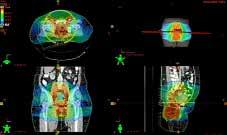 98 Carcinoma de ano En 50 pacientes se encontró información referente al tratamiento sistémico concurrente en la historia de radioterapia, en este grupo el esquema de quimioterapia más empleado fue