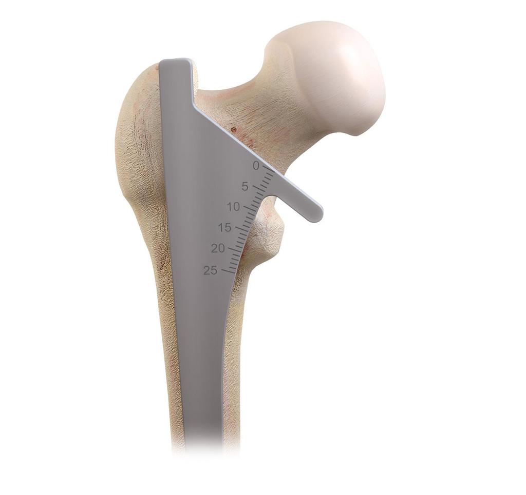 Osteotomía cervicofemoral Alinee la guía de resección cervicofemoral con el eje longitudinal del fémur.