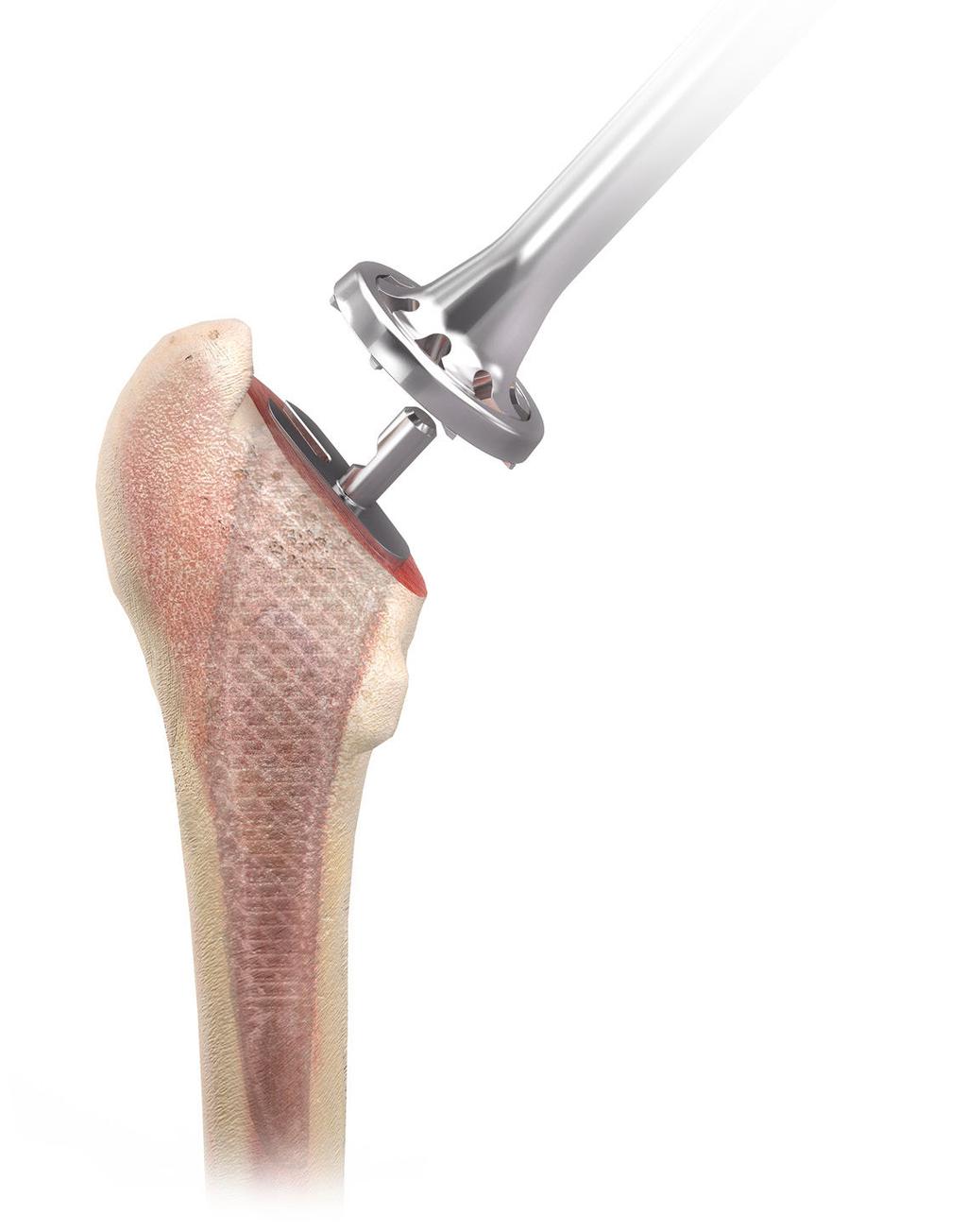 Preparación de la cavidad femoral El vástago TRI-LOCK de conservación ósea ofrece varios mangos de raspa que permiten múltiples abordajes quirúrgicos posibles para la artroplastia de cadera.