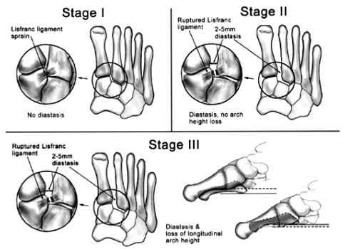 y el borde medial del segundo metatarsiano. FIGURA 5 Radiografía con carga comparativa en lesión de Lisfranc izquierda. Imagen adaptada desde Mark S. Myerson, M., and Rebecca A. Cerrato, MD (2008).