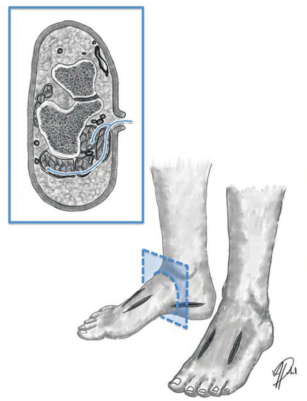 Capítulo 43: Traumatismos del pie VIII. Síndromes compartimentales A. Anatomía/fisiopatología 1.