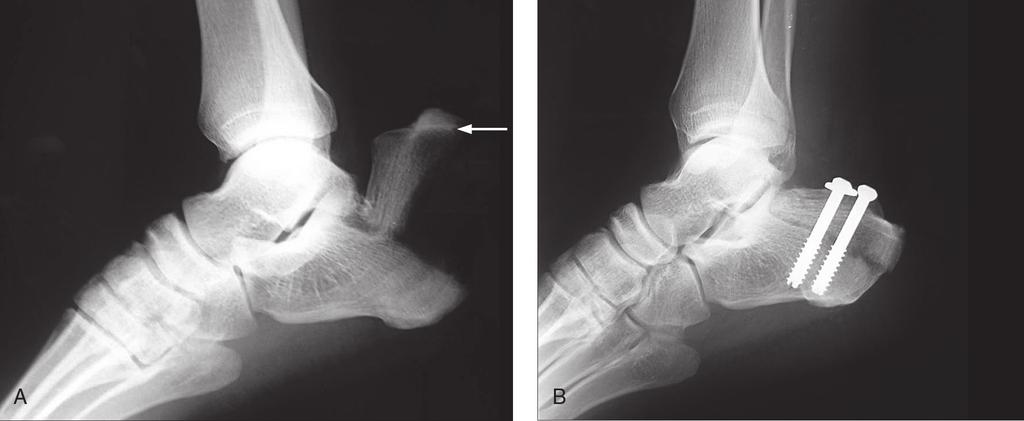 Sección Figura 4 Radiografías en proyección lateral preoperatoria (A) y postoperatoria (B) de un paciente con arrancamiento de la tuberosidad del calcáneo que precisó reducción y fijación urgentes