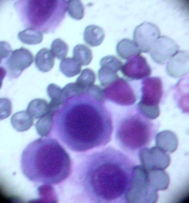 CLASIFICACIÓN CITOLÓGICA DE LOS TUMORES Tipo de tumor: Epitelial Tamaño celular: Grande Forma