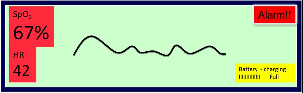 Qué nota usted en este oxímetro? El trazado es errático y sugiere que o el pulso es débil o el paciente se está moviendo.