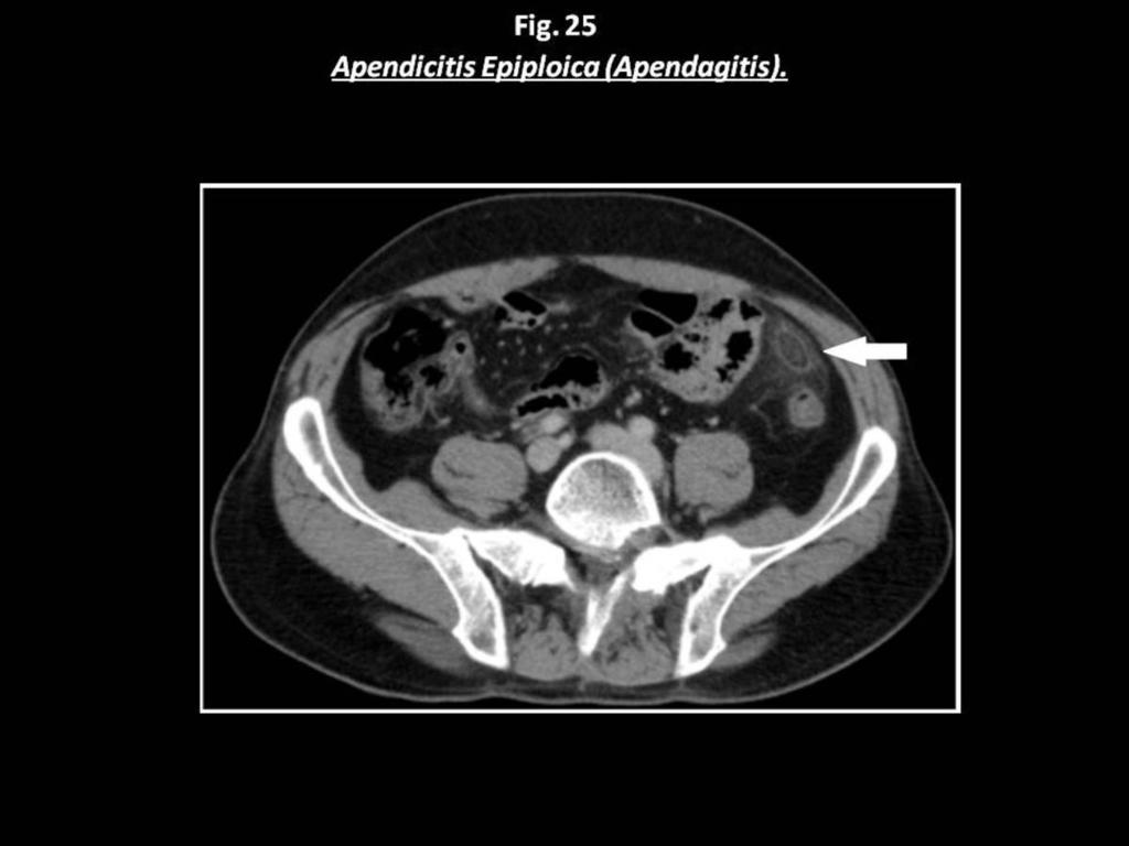 Fig. 25: Paciente con dolor abdominal centrado en FII en el que se observa una imagen ovoidea de densidad grasa, de bordes bien definidos e hipercaptación periférica, sin afectación de
