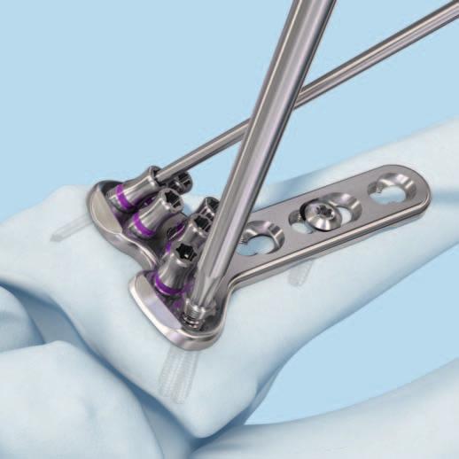 Implantación Proceda a introducir los tornillos de bloqueo de 2.4 mm en la porción distal de la placa, en los agujeros que considere más adecuados según el tipo fractura.