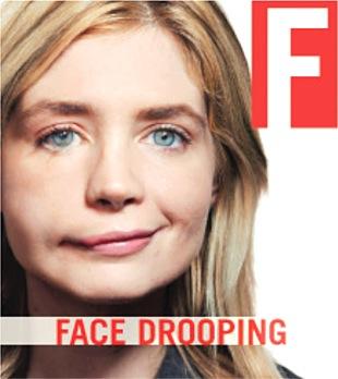 Las señales de un accidente cerebrovascular Face Drooping (Rostro caído) Está uno de los lados del rostro caído o entumecido? Pídale a la persona que sonría.