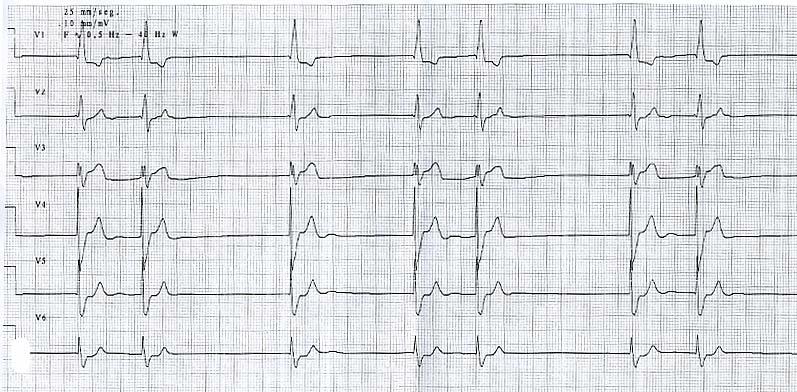 Ronda de las Provincias, 7 28011 - Madrid Imagen 4 b Pregunta 1: Con los datos actuales, lo más probable es que el paciente padezca: a) Síndrome coronario agudo b) Tromboembolismo pulmonar c)