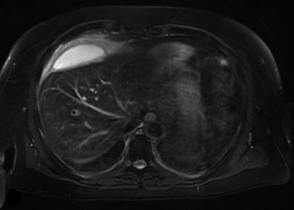 Fig. 5: Paciente masculino de 67 años de edad, intervenido de colecistectomía laparoscopica 10 días antes.