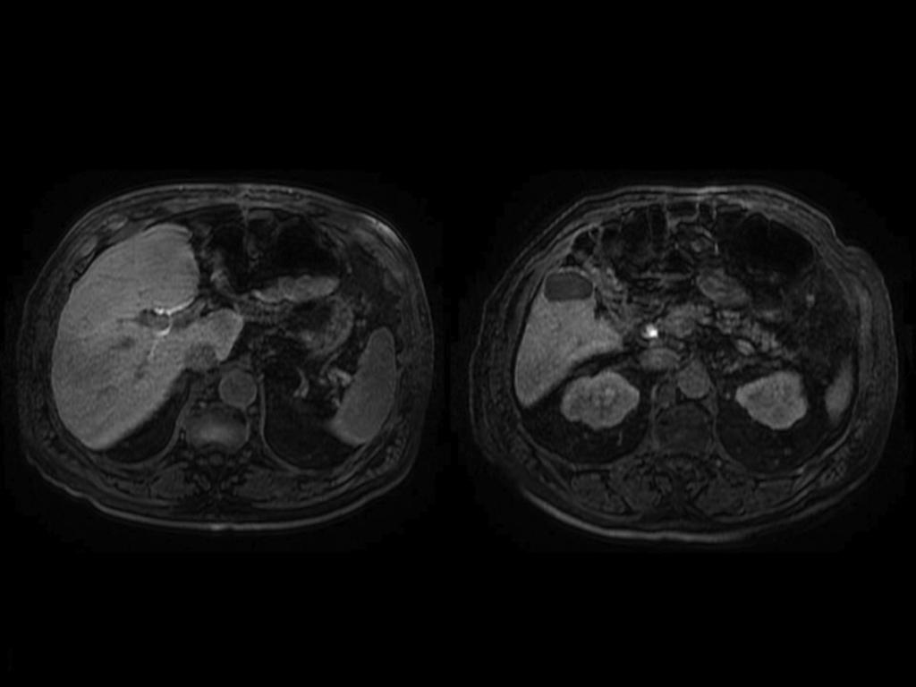 Fig. 10: Paciente hombre de 81 años que se intervino de colecistectomía laparoscopica 7 días antes (imágenes 9 y 10).