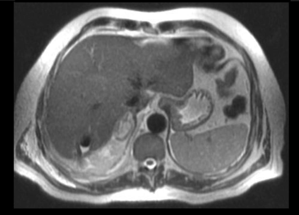 Fig. 11: Paciente de 61 años de edad,intervenido 20 dias antes de resección de metástasis hepáticas por carcinoma de colon( imágenes 11,12,13,14 y 15).