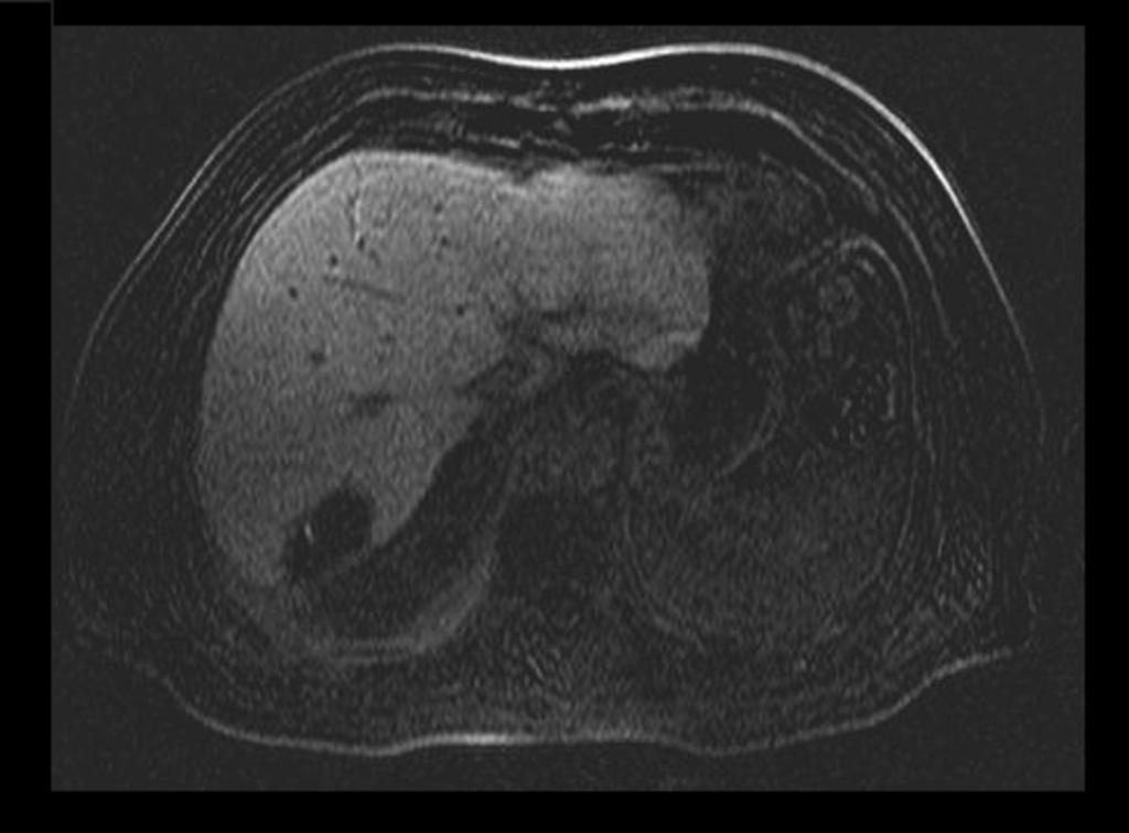 Fig. 14: Paciente de 61 años de edad,intervenido 20 dias antes de resección de metástasis hepáticas por carcinoma de colon( imágenes 11,12,13,14 y 15).