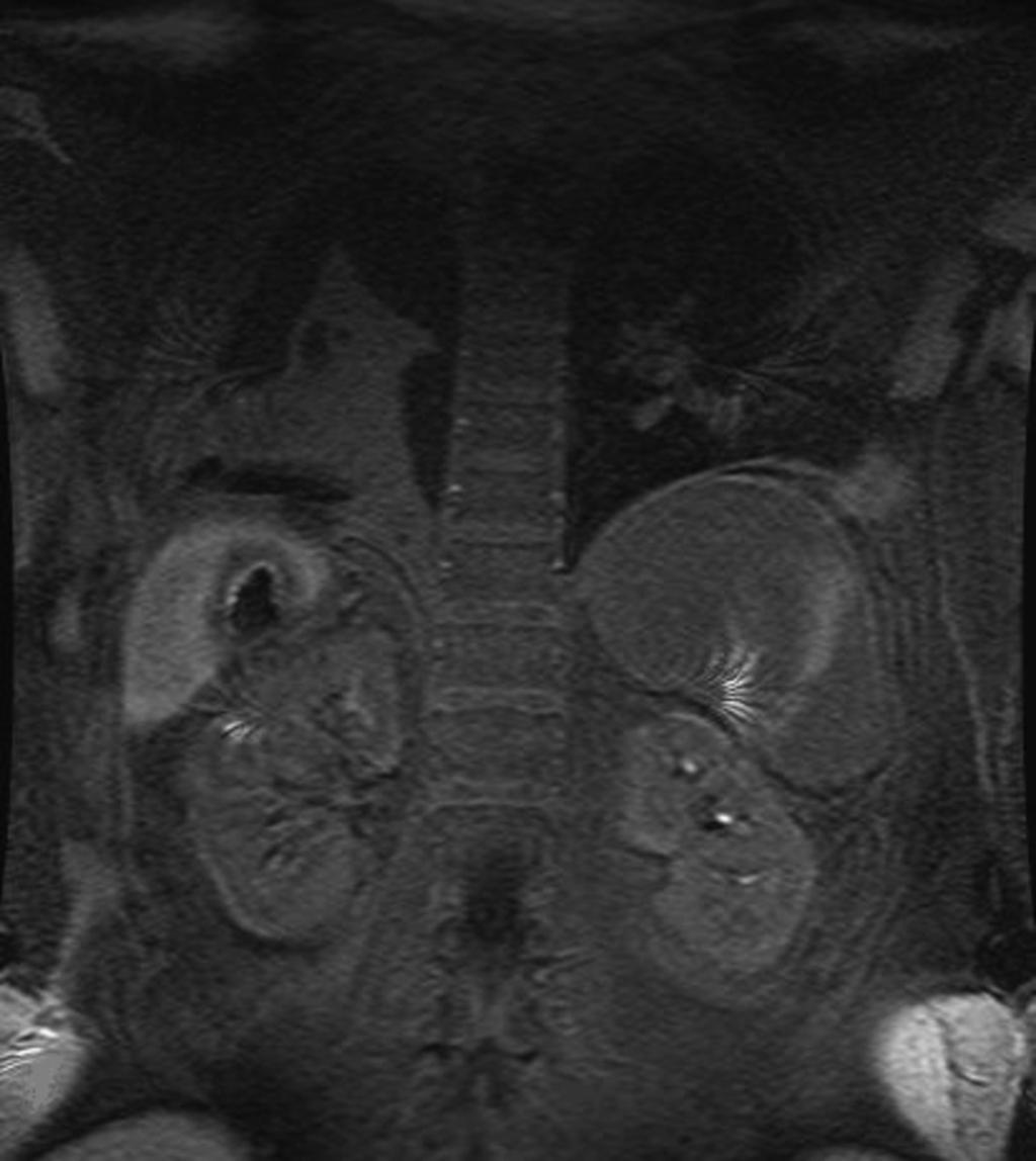 Fig. 15: Paciente de 61 años de edad,intervenido 20 dias antes de resección de metástasis hepáticas por carcinoma de colon( imágenes 11,12,13,14 y 15).