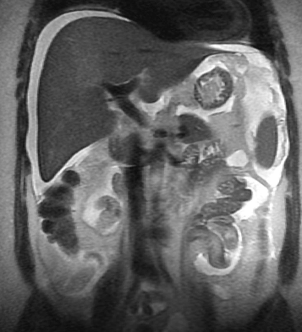 Fig. 19: Mujer de 37 años operada de colecistectomia laparoscopica, dolor en hipocondrio derecho. En la imagen T2 en plano coronal (fig. 20) se observa abundante liquido libre intra abdominal.