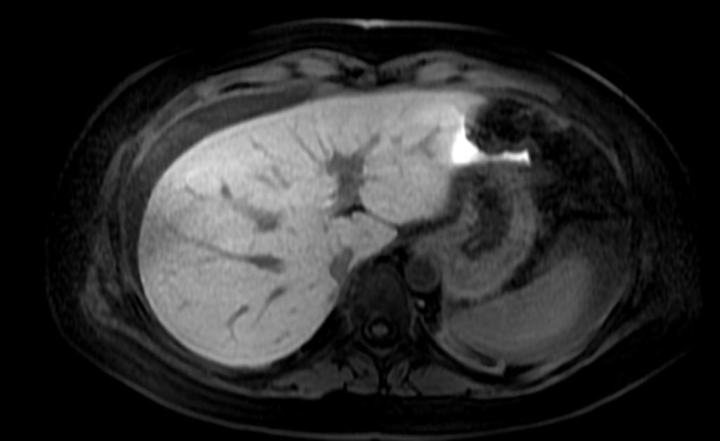 Fig. 20: Mujer de 37 años operada de colecistectomia laparoscopica, dolor en hipocondrio derecho. En la imagen T2 en plano coronal (fig. 20) se observa abundante liquido libre intra abdominal.