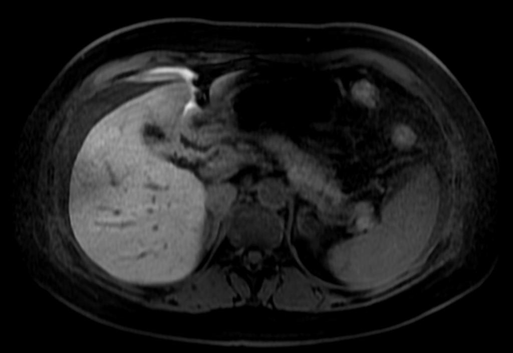 Fig. 21: Mujer de 37 años operada de colecistectomia laparoscopica, dolor en hipocondrio derecho. En la imagen T2 en plano coronal (fig. 20) se observa abundante liquido libre intra abdominal.