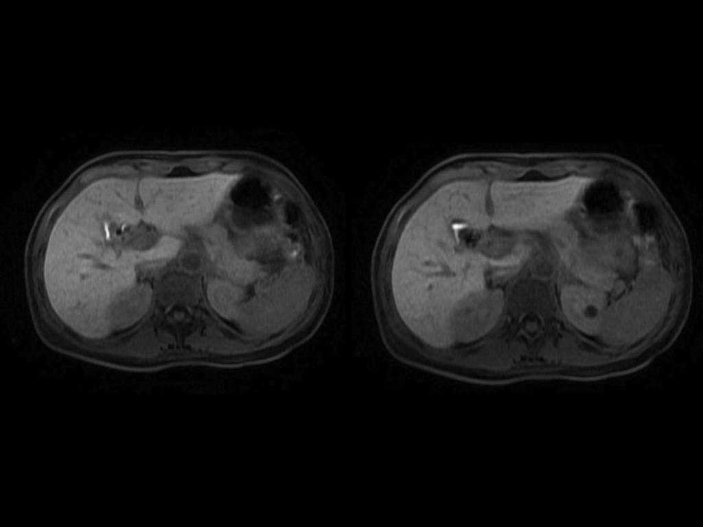 Fig. 2: Paciente varón de 53 años, con colecistectomía laparoscopica 15 días antes (imagenes 2,3 y 4).