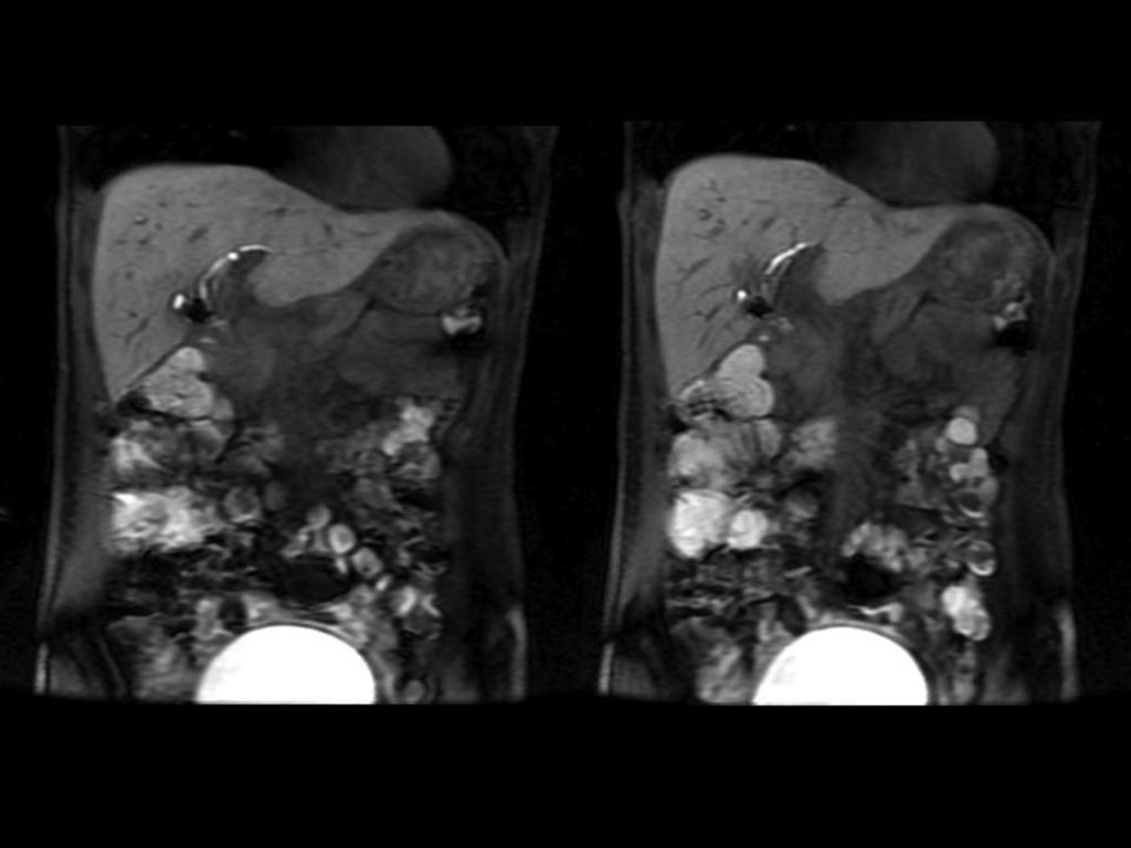 Fig. 3: Paciente varón de 53 años, con colecistectomía laparoscopica 15 días antes (imagenes 2,3 y 4).