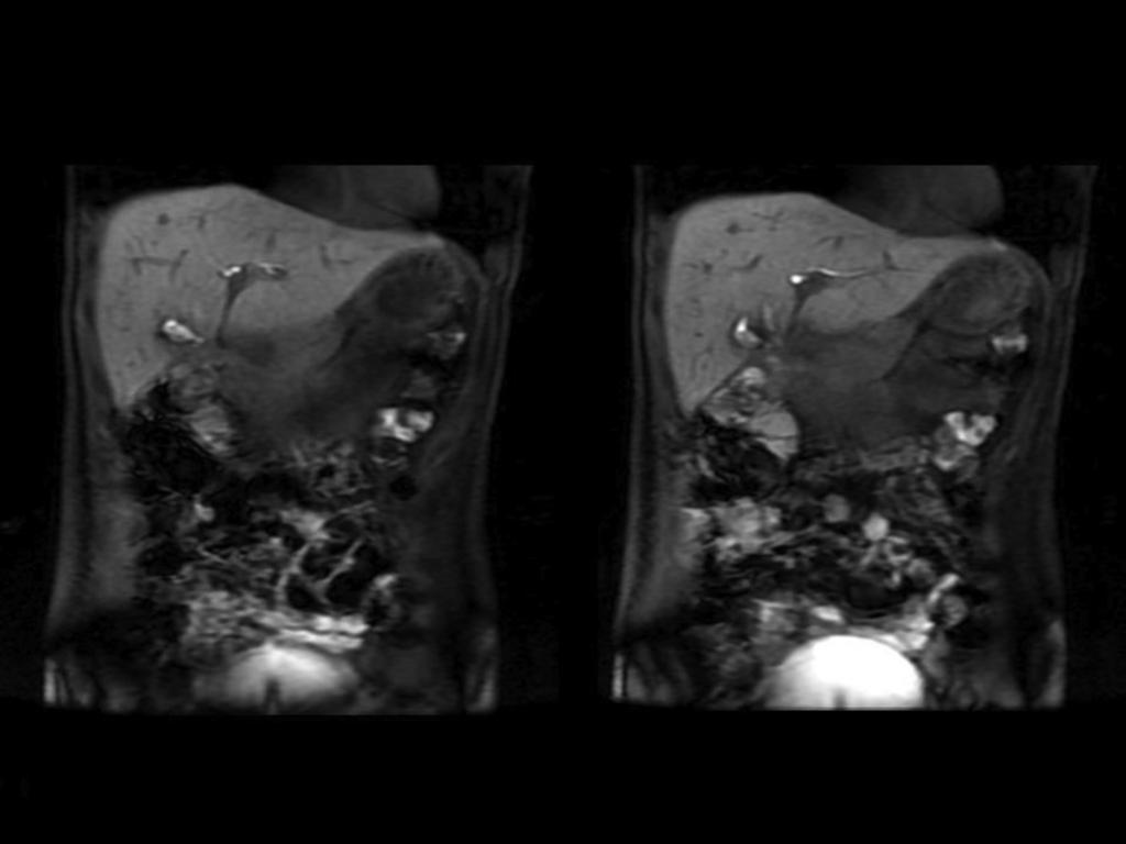 Fig. 4: Paciente varón de 53 años, con colecistectomía laparoscopica 15 días antes (imagenes 2,3 y 4).