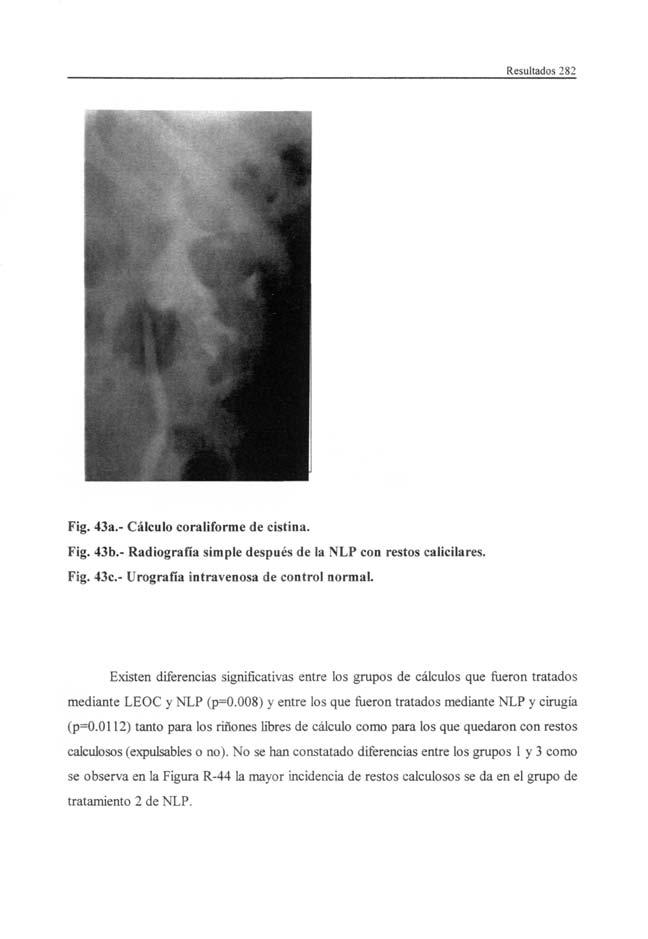 Resultados 282 Fig. 43a.- Cálculo coraliforme de cistina. Fig. 43b.- Radiografía simple después de la NLP con restos calicilares. Fig. 43c- Urografía intravenosa de control normal.