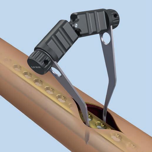 Instrumentos para la osteosíntesis escasamente traumática Soporte para separadores de Hohmann El portaseparadores de Hohmann se ha concebido para su uso en la osteosíntesis de placa percutánea y