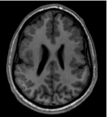 Imágenes axiales en T1 y T2 ponderados en una niña de 12 años de edad con hipotonía, retraso gobal del desarrollo y epilepsia, mostrando delgadez de la formación del giro frontal y temporal,