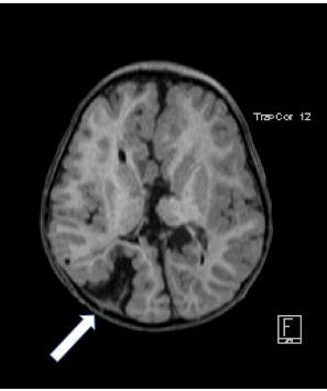 Neuroimágenes en la epilepsia pediátrica. o con trastornos vasculares o infecciosos durante el desarrollo temprano del cerebro (Guerrini & Zellini, 2011; figura 16).
