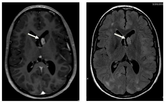Neuroimágenes en la epilepsia pediátrica. tológicas incluyen fibromas ungueales o periungueales, máculas hipomelanóticas y el parche Shagreen.