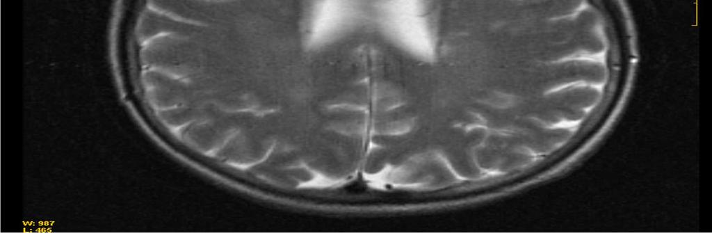 RM cerebral: Lesiones isquémicas por vasculopatía de pequeño vaso en sustancia blanca