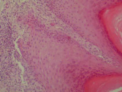 A nivel del estrato basal se visualiza degeneración hidrópica o vacuolar de las células epidérmicas, con espongiosis y borramiento de la interfase dermoepidérmica por un infiltrado