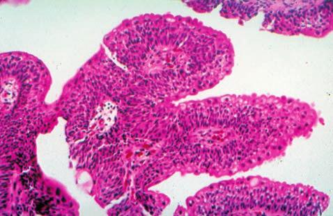 Neoplasia de bajo potencial maligno: Se observa un crecimiento papilar con polaridad conservada, más de 7 capas celulares, con núcleos agrandados pero uniformes en su forma y tamaño.