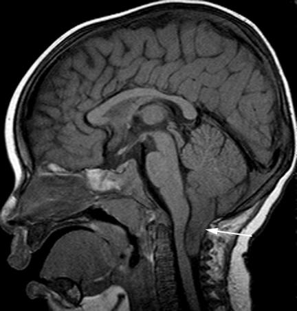 Malformaciones de Chiari Grupo heterogéneo de MF con alteración anatómica del cerebelo y TE.