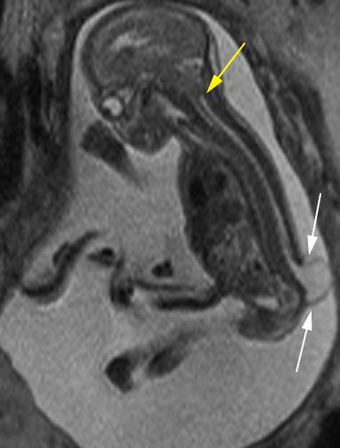 Malformaciones de Chiari Tipo II: MF Arnold Chiari Desplazamiento caudal del vermis cerebeloso y TE.