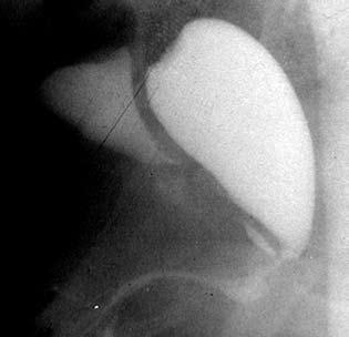 Trayecto largo que remeda una uretra masculina con una desembocadura vaginal alta cercana al cuello vesical de un orificio uretral