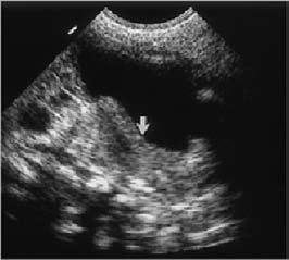 La primera se realizó con el fin de explorar y reconocer estructuras intraabdominales, pelvianas e inguinales, confirmando la presencia de útero y ovarios, y la visualización del área suprarrenal.